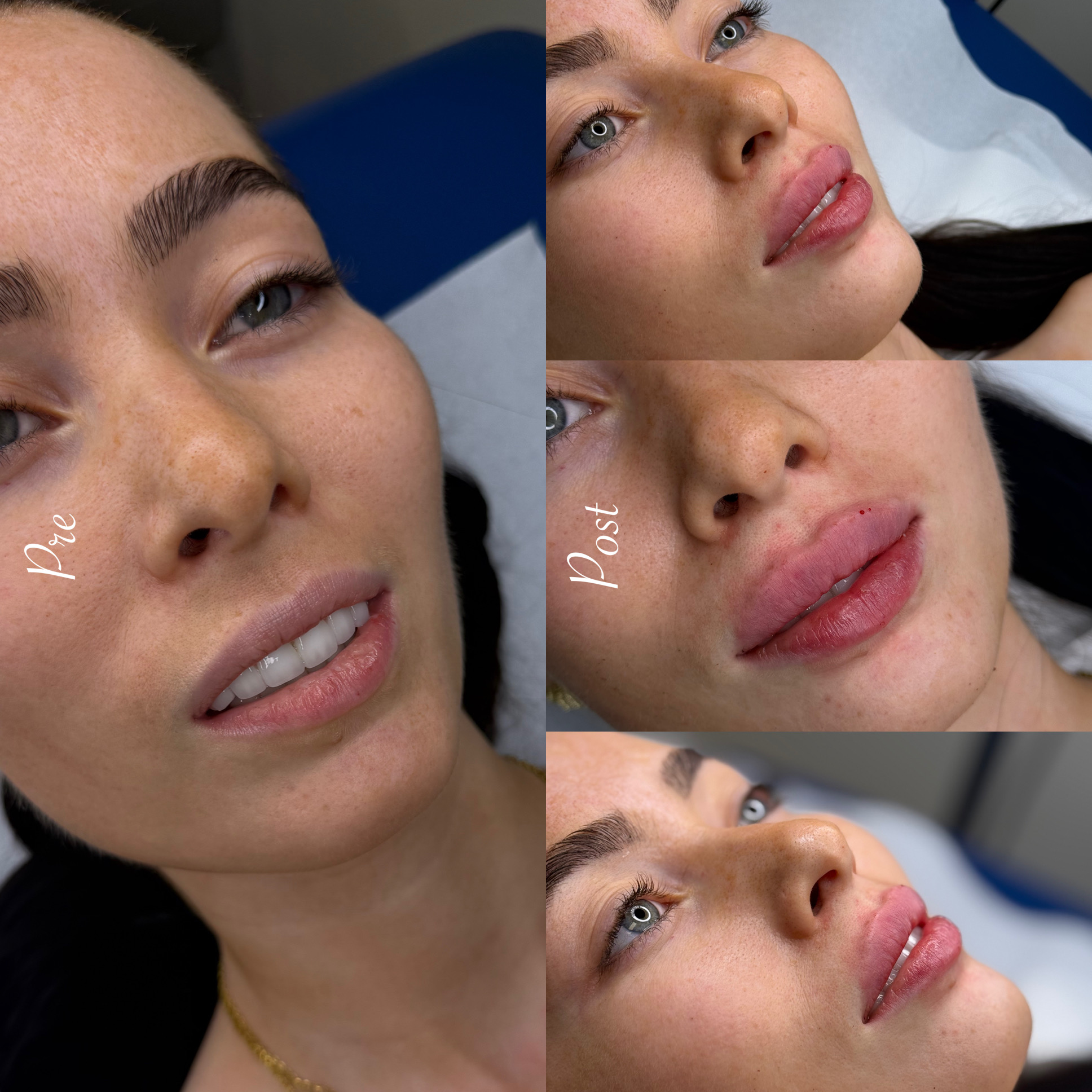 Filler labbra